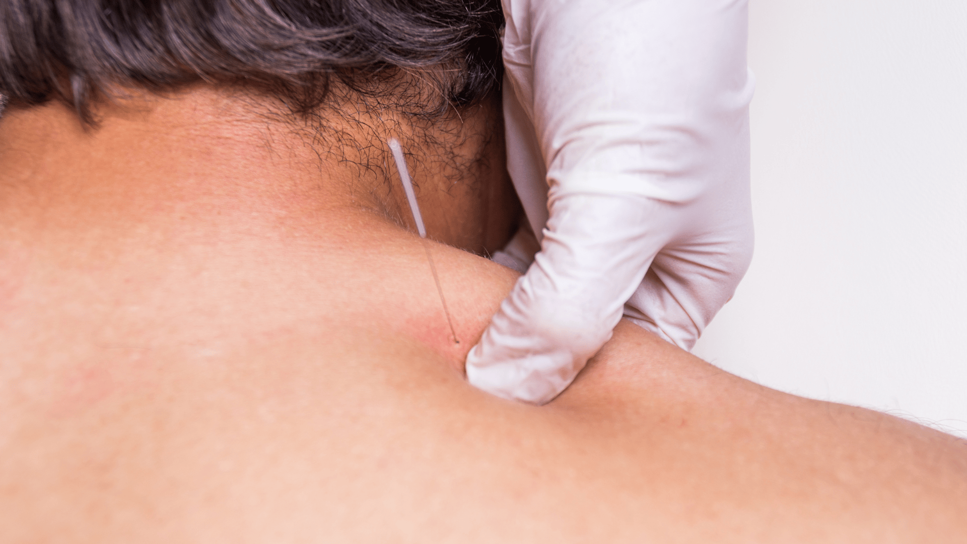 Dry Needling